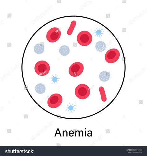 Specimen Anemia Disease Concept Human Blood Stock Vector Royalty Free