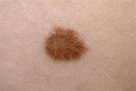 Skin Cancer Cells All You Should Understand About Non Melanoma Skin