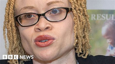 People With Albinism In Malawi Face Total Extinction Un Bbc News
