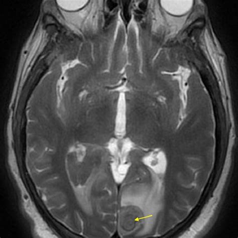 Brain Magnetic Resonance Imaging Mri Demonstrating Focus Of Acute