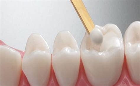 Advantages Of White Dental Fillings Top Rated Cosmetic And General