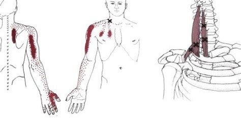 What You Need To Know About Muscle Knots Or Trigger Points Healing Art Community Muscle