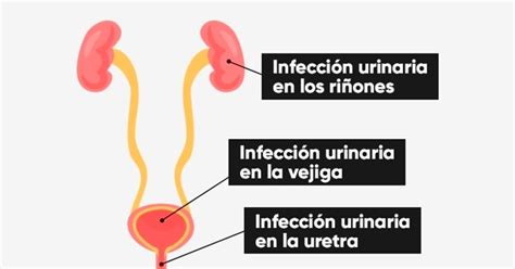 La Infección Urinaria Puede Llegar Hasta Los Riñones Tua Saúde