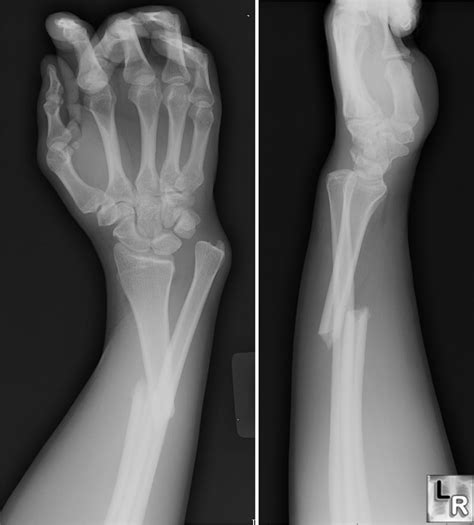 Learningradiology Galeazzi And Monteggia Fracture Dislocations