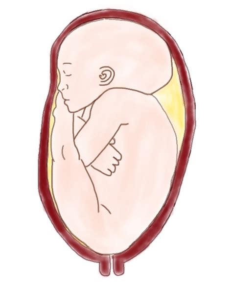 Dolichocephaly Understanding ‘breech Head Molding The