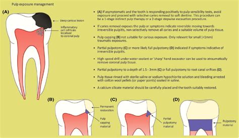 Schematic Illustration Of Conservative Deep Caries Management Approach