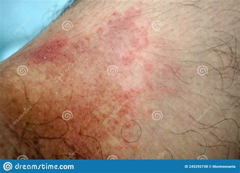 Itchy Rash In The Groin Area Tinea Cruris Is A Type Of Skin Disease