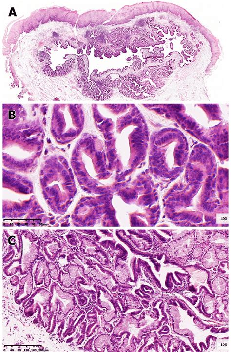 Histological Features Of Esophageal Submucosal Gland Duct Adenoma