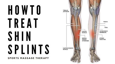 Sports Massage Therapy Treating Shin Splints Medial Tibial Pain