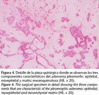 Pleomorphic adenoma in minor salivary glands trabajo recibido el 22/04/2003. Adenoma Pleomorfo; Siringoma Condroide; Tumor Misto de ...