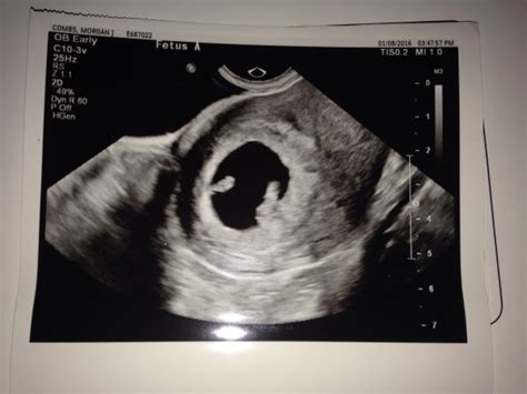 7 Week Ultrasound Twins Photo Babycenter