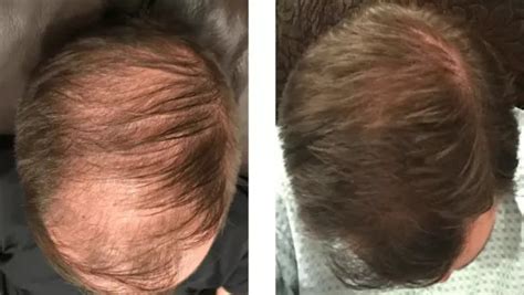 Minoxidil Before And After Photos 2022 Is It Right For You