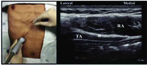 Transversus Abdominis Plane Block Subcostal Approach 11 Download Scientific Diagram