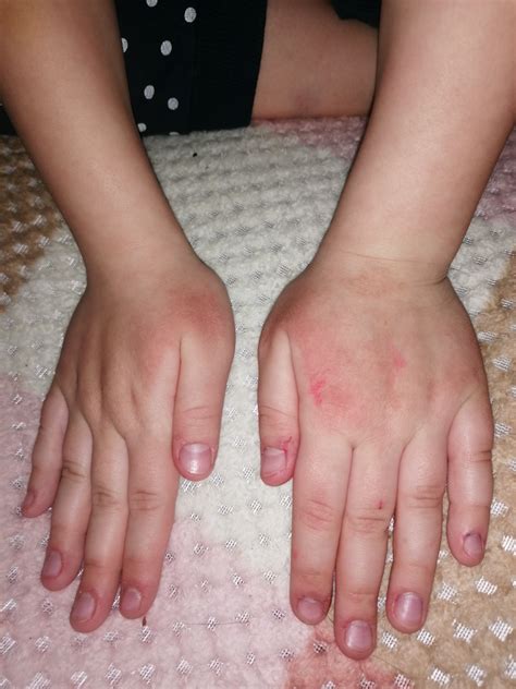 Покраснение на руках у ребёнка что делать Вопрос дерматологу 03