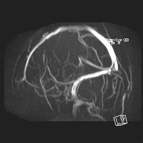 The most frequent and often early symptom of thrombosis of cerebral veins and sinuses is a headache. Dural venous sinus thrombosis | Radiology Case ...