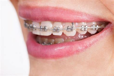 An overjet is the name dentists give to the amount that upper front