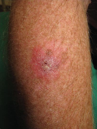 Basal Cell Carcinoma On Arm