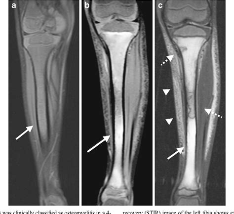Utility Of Unenhanced Fat Suppressed T1 Weighted Mri In Children With