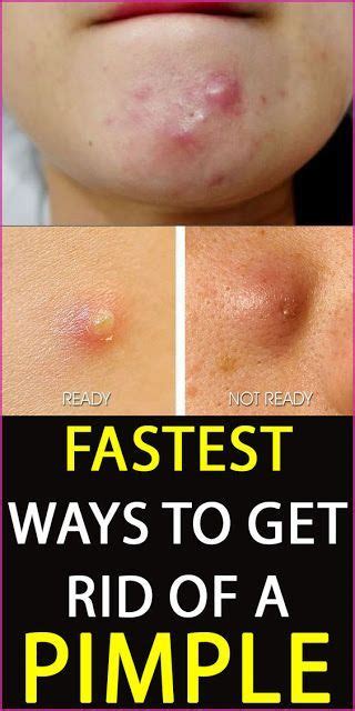 10 Ways To Get Rid Of A Pimple Overnight In 2020 How To Cure Pimples