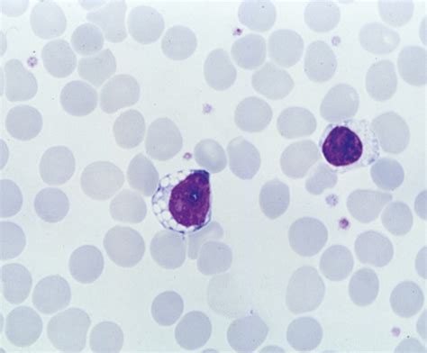 Vacuoles In The Cytoplasm Of A Peripheral Blood Lymphocyte From A