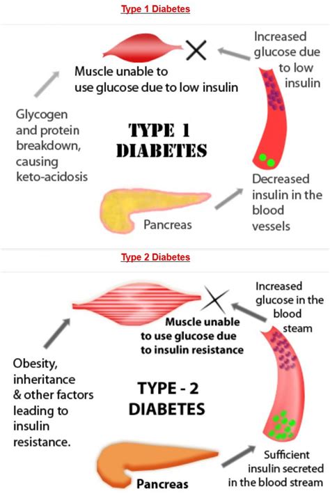 Diabetes Guide A Social Group For Diabetic Individuals