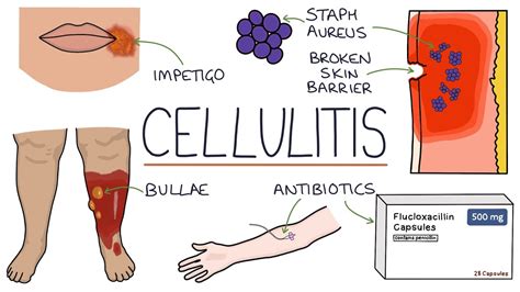 Cellulitis Knee