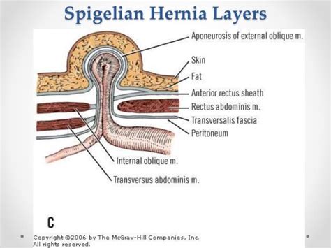 Anatomy Of Abdominal Wall Ppt Hernia Powerpoint Presentation Free