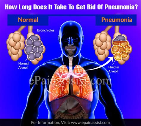 The pressure of the persons weight cuts of the circulation in that in the short term, immobility sometimes has its uses; How Long Does It Take To Get Rid Of Pneumonia?