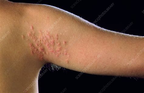 Cutaneous Larva Migrans Rash On Upper Arm Stock Image M2000043