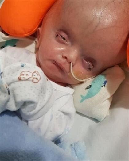 In Pics Miracle Baby Born With Crushed Skull Defies Doctors Odds To