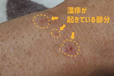男だけど腕毛を脱毛したい!ムダ毛のせいでかゆくなるので ...