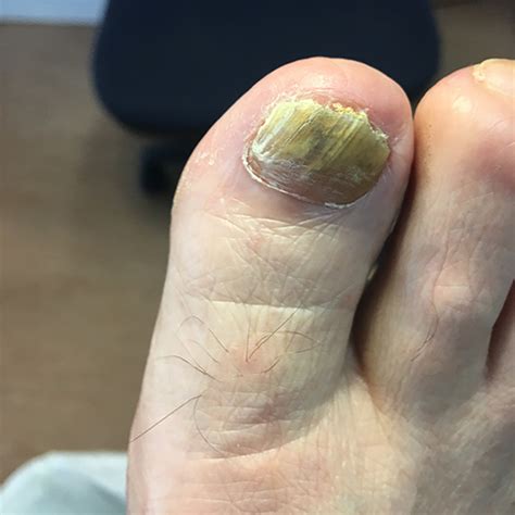 fungal nail infection causes symptoms and treatment