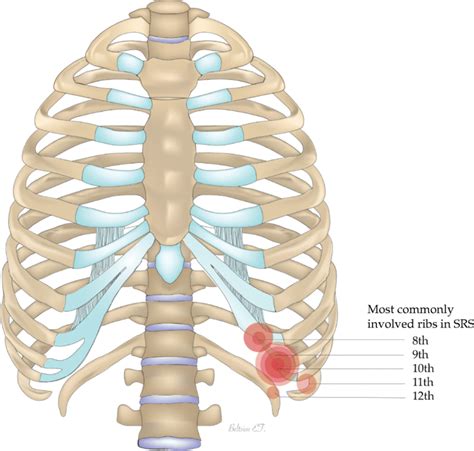 The Most Commonly Involved Ribs In Slipping Rib Syndrome Image