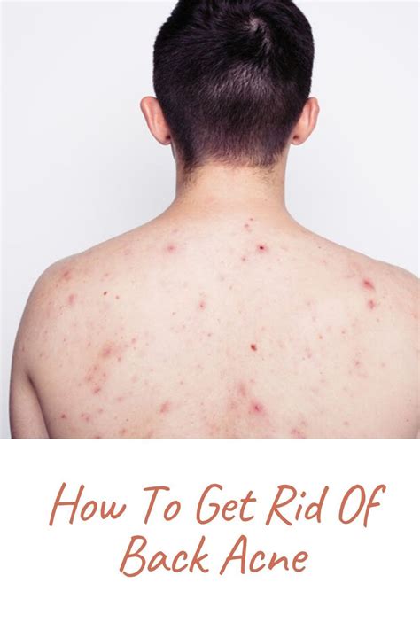 Back Acne Treatment