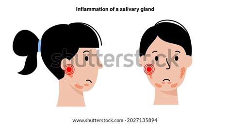 Inflammation Salivary Glands Human Mouth Parotid Vetor Stock Livre De