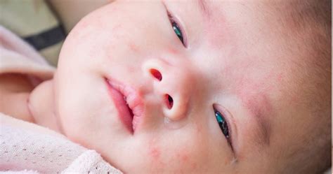 See full list on blog.madeof.com Baby Food Allergy Rash - Causes, Symptoms & Natural Treatments