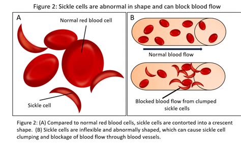 Detecting Hemoglobin Variants During Sickle Cell Disease Research