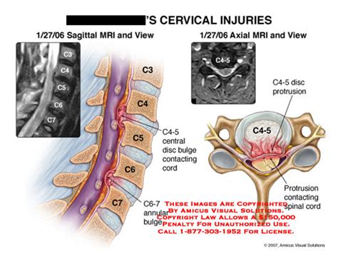 Amicus Illustration Of Amicusinjurycervicalinjuriesdiscbulge