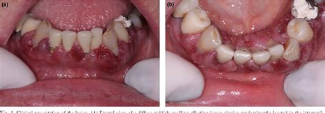 Figure 1 From Gingival Granulomatosis With Polyangiitis Wegener S