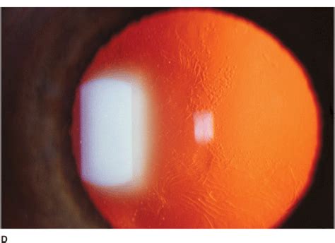 Epithelial basement membrane dystrophy (ebmd). Corneal Dystrophies | Ento Key