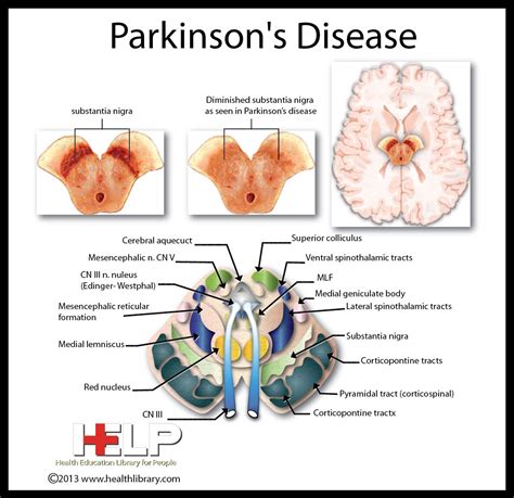 Parkinson Disease Pathophysiology Pdf Madelinebethel