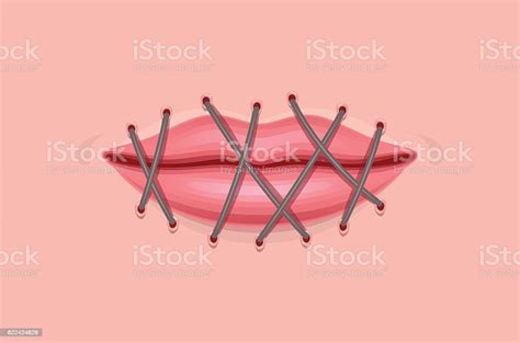Stitch Lips Stock Illustration Download Image Now Closed Medical