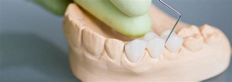 Rehabilitación Oral ¿cómo Se Realiza Una Prótesis Dental Puente Dental