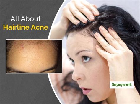 Hairline Acne What Is This And How This Can Be Treated Onlymyhealth