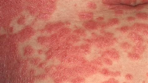 Psoriasis Rash What It Looks Like And How To Deal Laptrinhx News