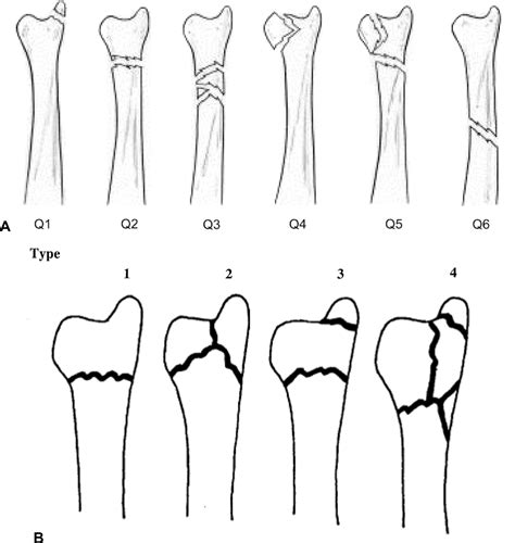 Distal Ulna Fractures Journal Of Hand Surgery