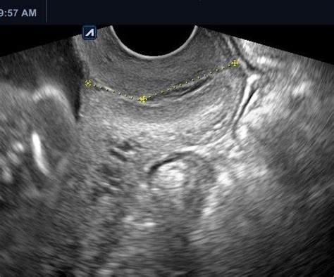 Transvaginal Ultrasonographic Measurement Of Cervical Length