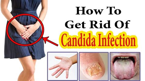 How To Get Rid Of Candida Infection Home Remedies For Candida Treatment Youtube