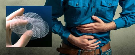 Check spelling or type a new query. Abdominal Mesh - Defective Medical Device Attorneys