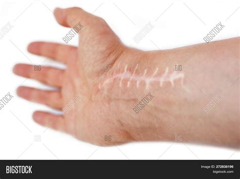 Scar Stitches On Wrist Image And Photo Free Trial Bigstock